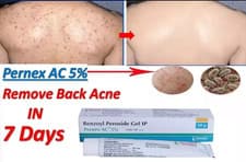 Image of Benzoyl Peroxide Gel for remove back Acne & black spots 20 gm pack of 2