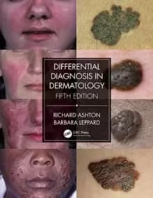 Image of Differential Diagnosis in Dermatology