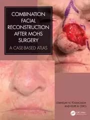 Image of Combination Facial Reconstruction after Mohs Surgery A Case Based Atlas