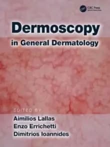 Image of Dermoscopy in General Dermatology